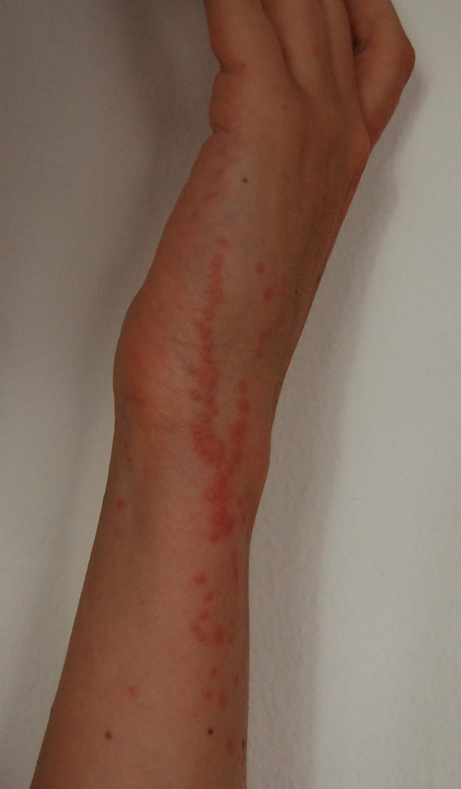Plusieurs piqûres de punaise de lit alignées sur le poignet, papules rouges en relief